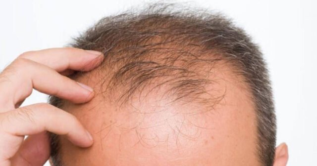 Se ha identificado una causa inesperada de calvicie de patrón masculino
